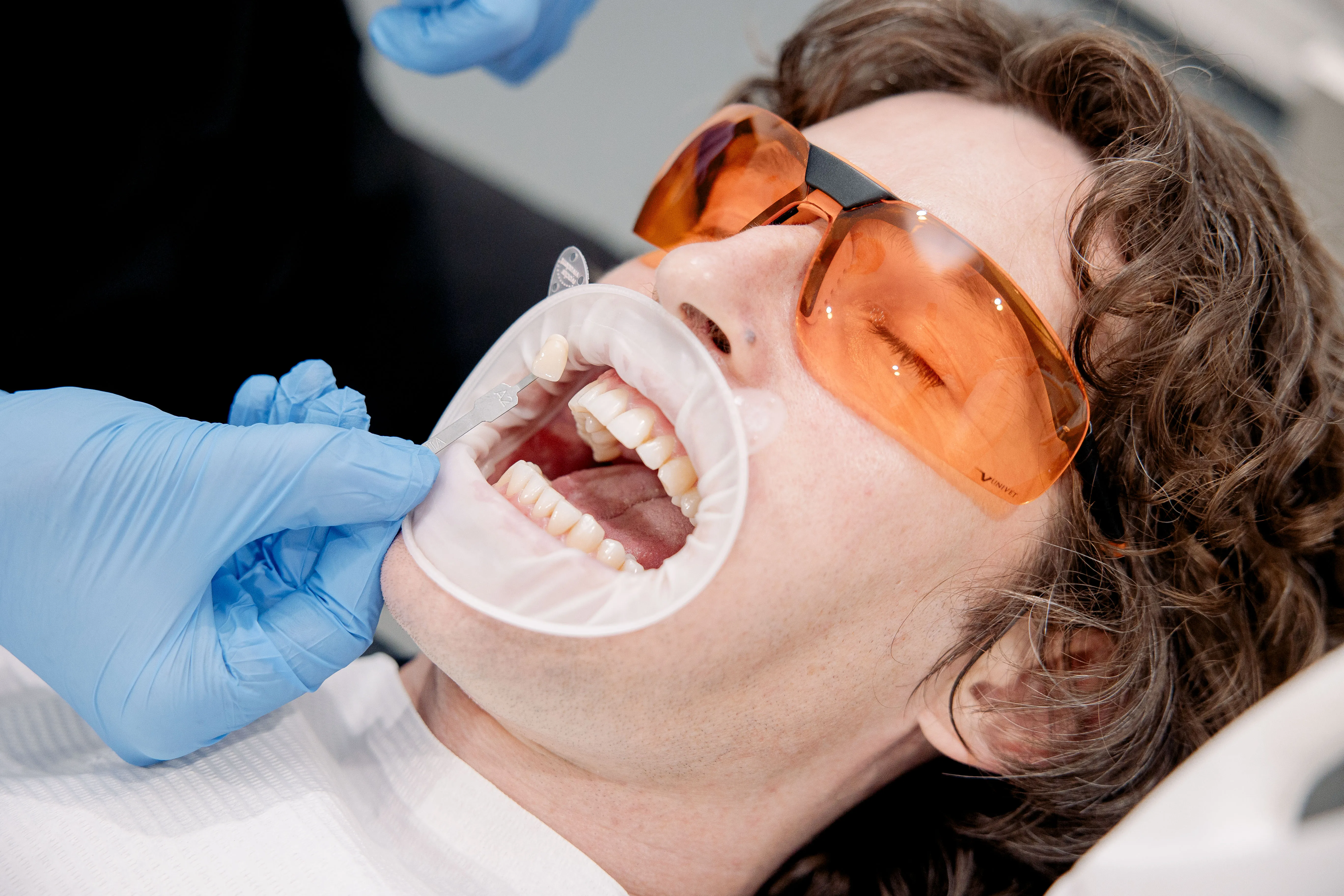 Teeth Whitening Sydney | Zoom Whitening From $600 | My Local Dentists Before and After Example