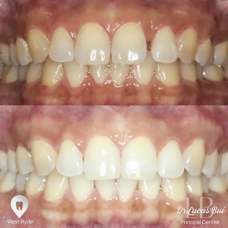 Clear Aligners transformation complete!