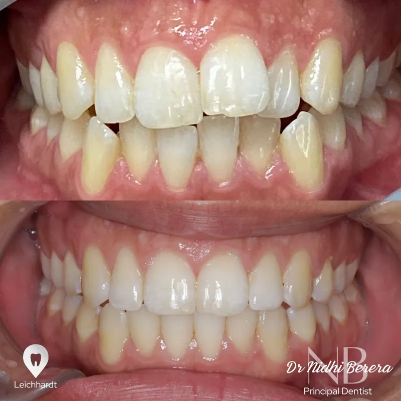 Clear Aligners transformation complete!