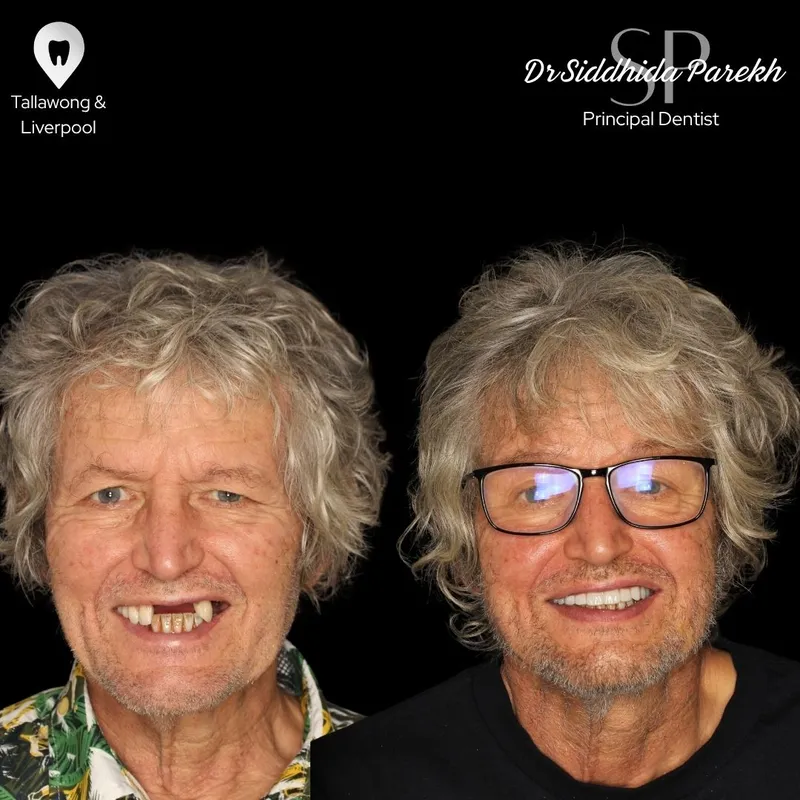 Implants transformation complete!