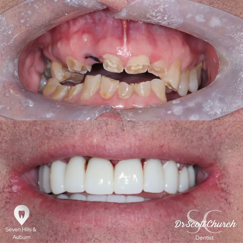 Implants transformation complete!