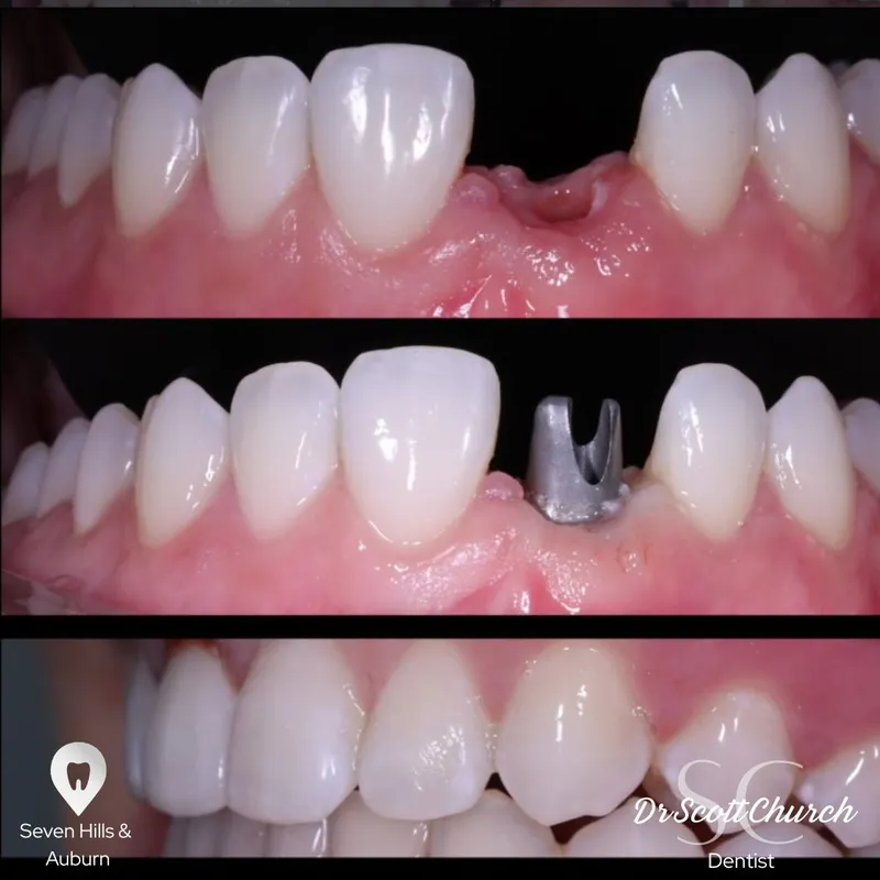 Implants transformation complete!