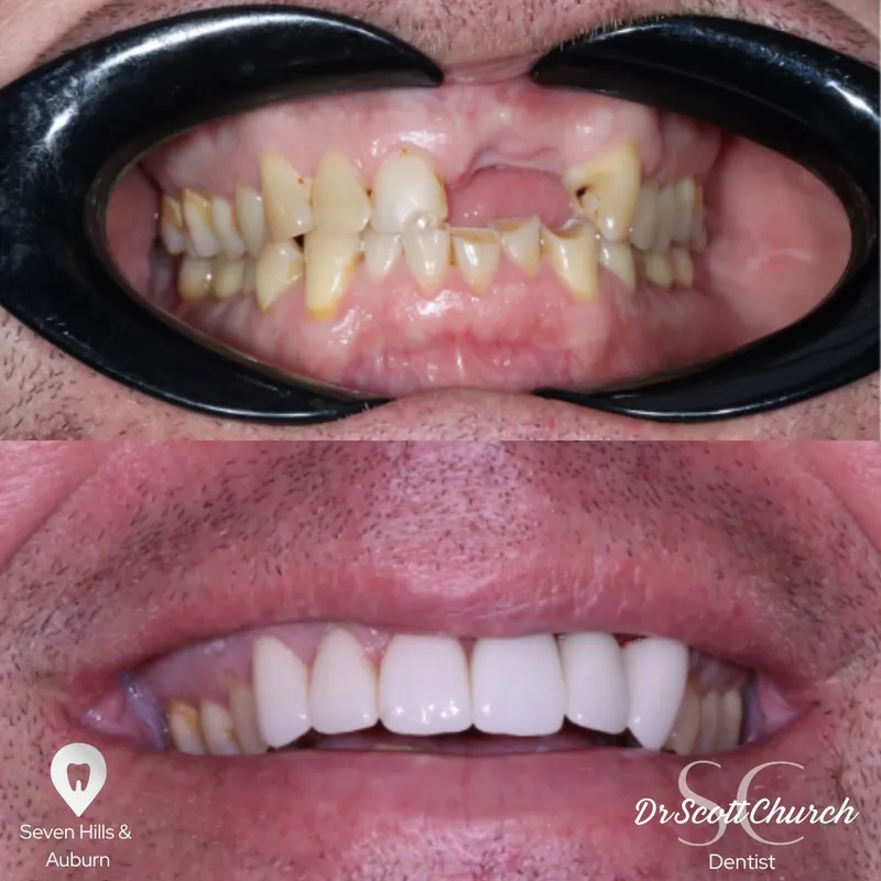 Veneers transformation complete!