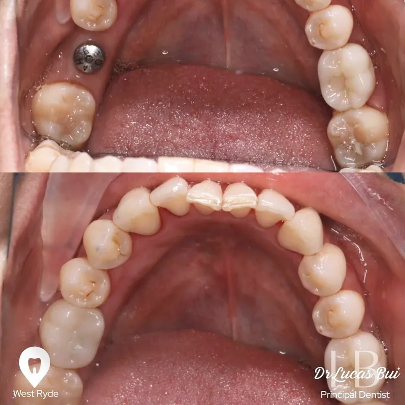 Implants transformation complete!