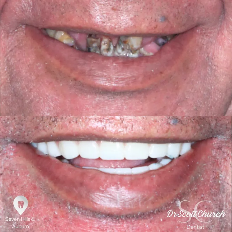 Implants transformation complete!