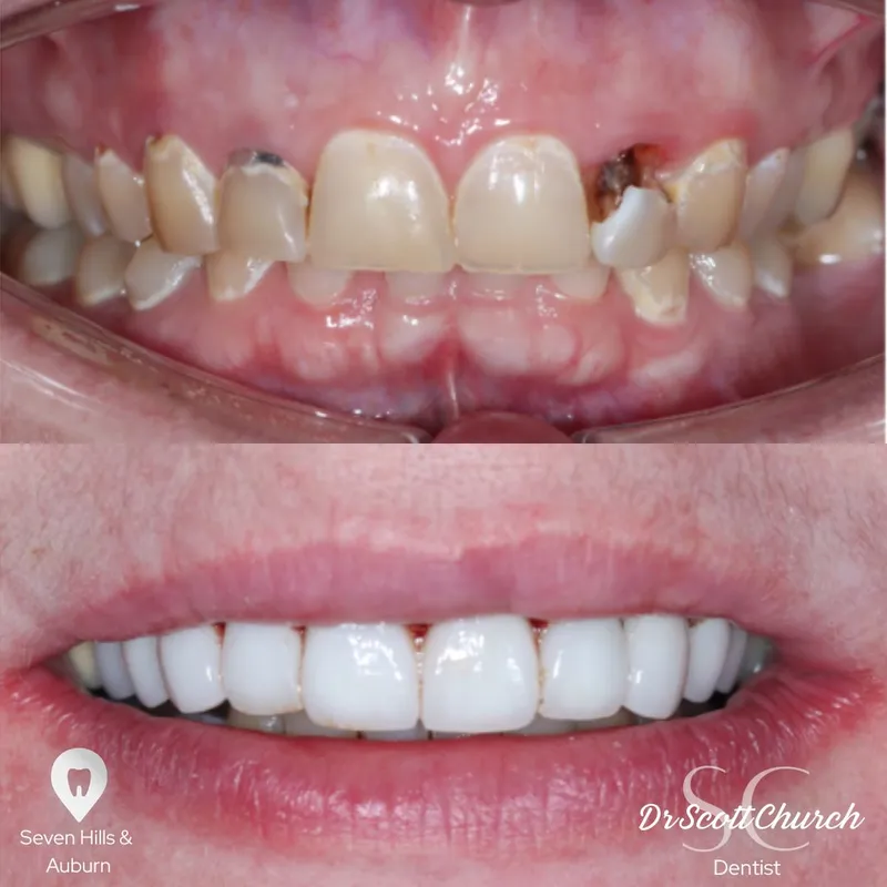 Veneers transformation complete!