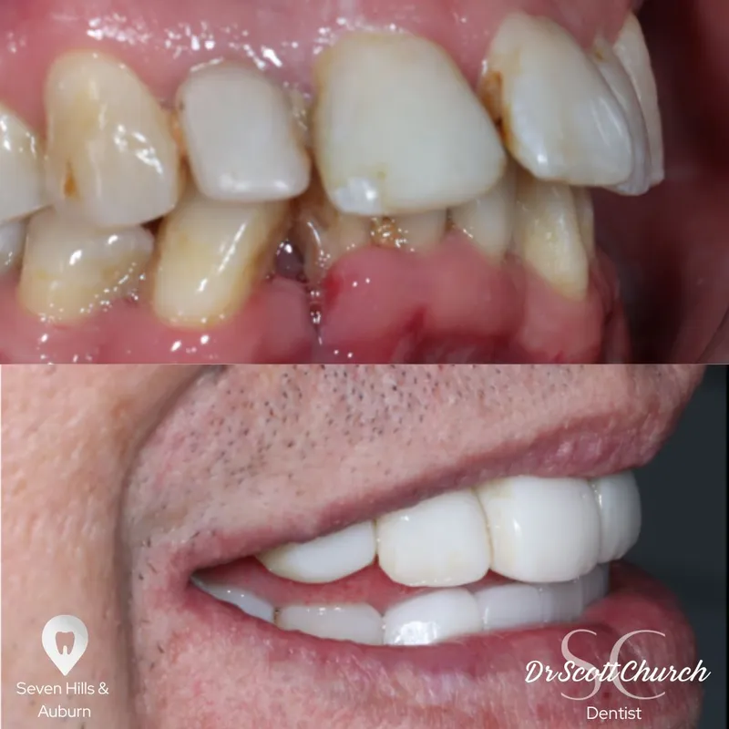 Veneers transformation complete!