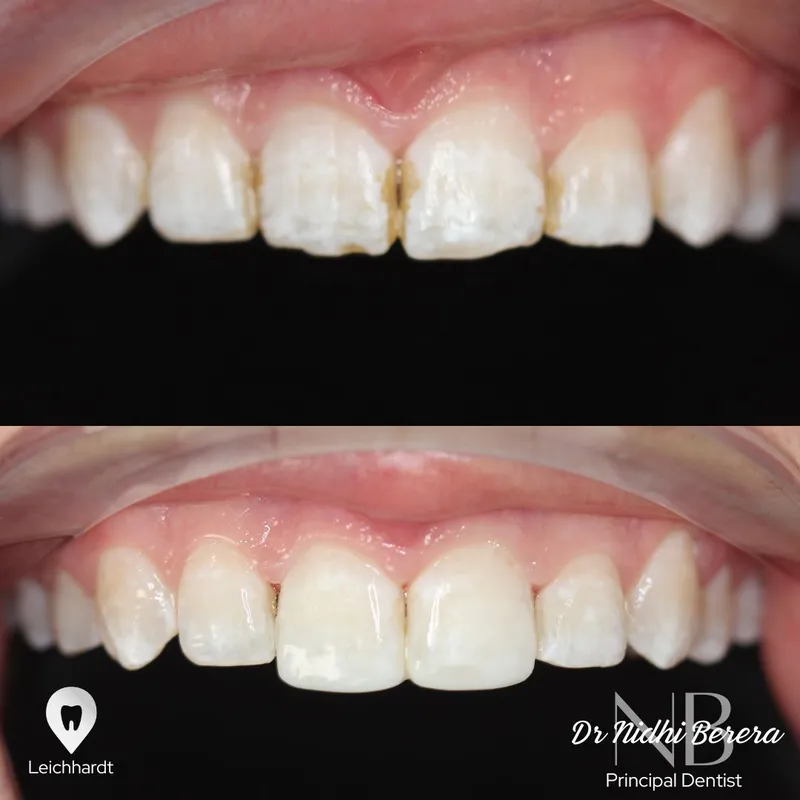 Veneers transformation complete!