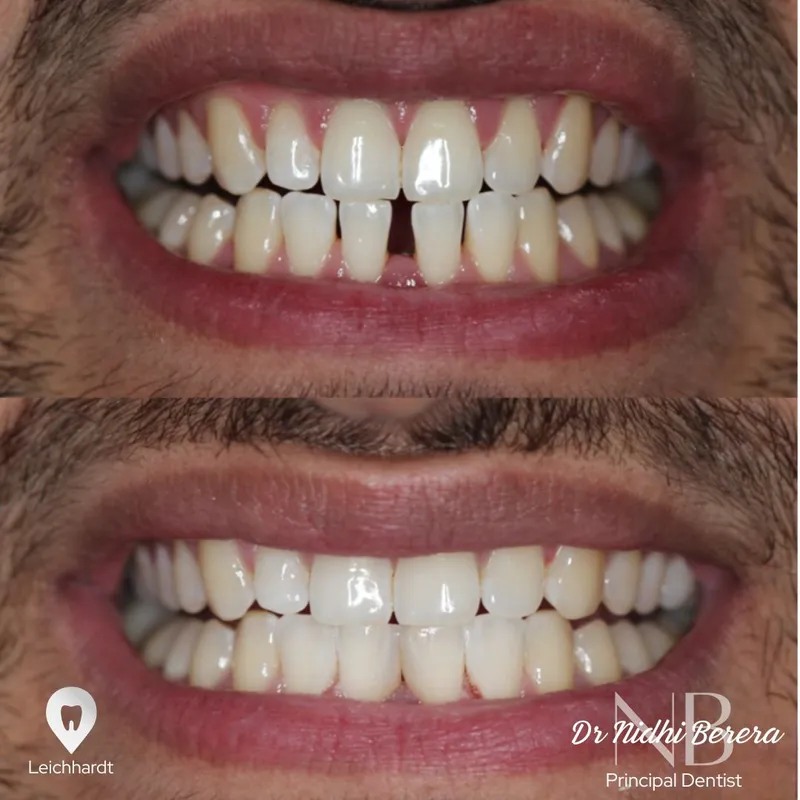 Veneers transformation complete!