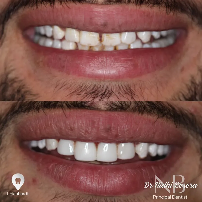 Veneers transformation complete!
