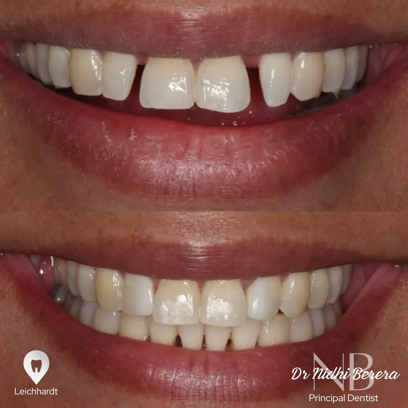 Veneers transformation complete!