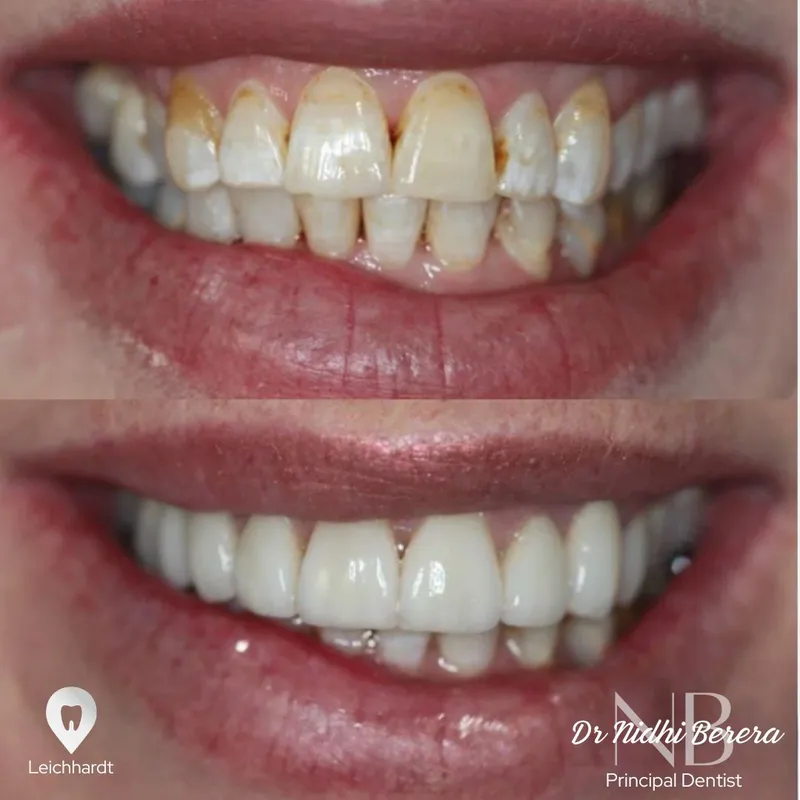 Veneers transformation complete!