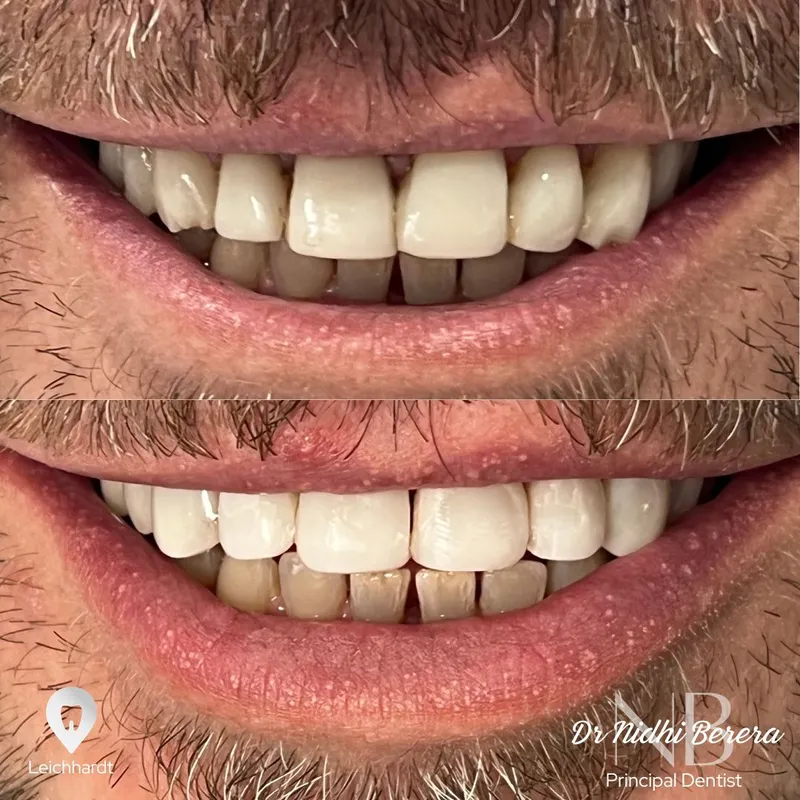 Veneers transformation complete!