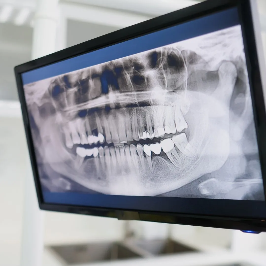 Digital dental X-ray displayed on a chairside screen during an emergency assessment