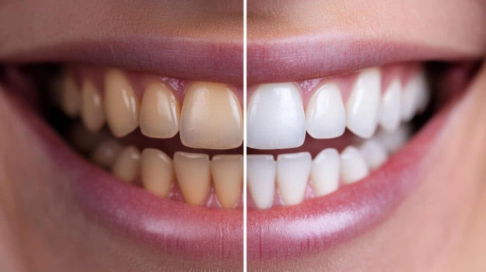 How to Remove Stains From Teeth: 10 Proven Methods for a Brighter Smile