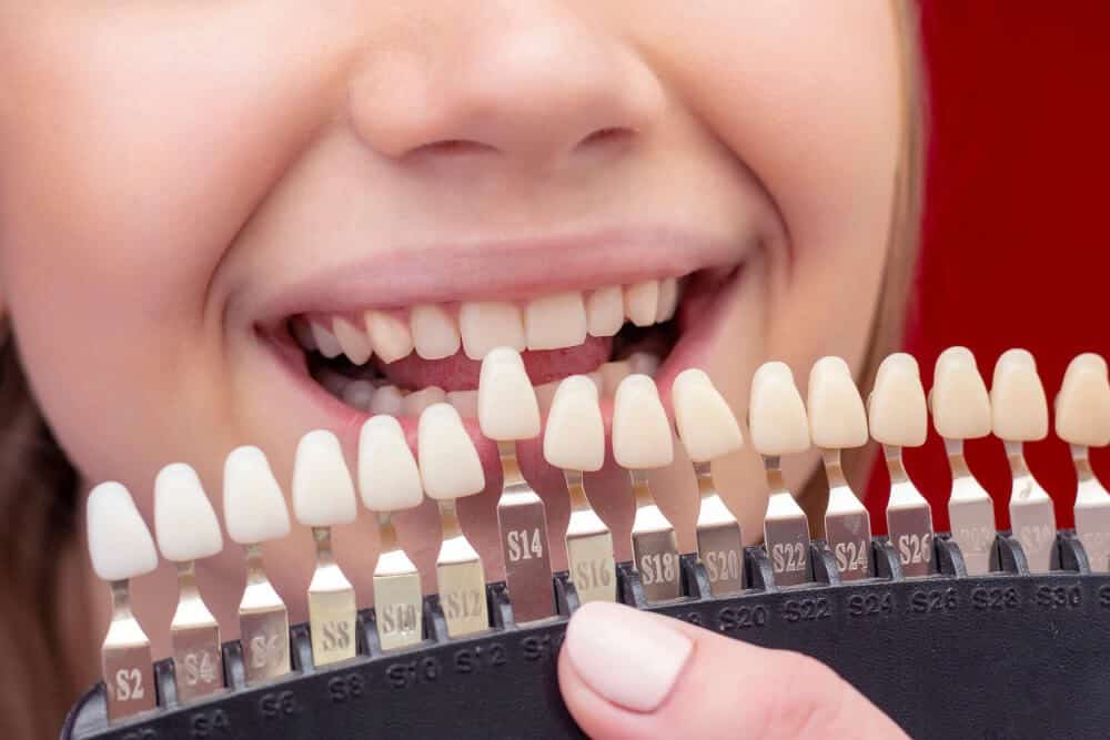 Porcelain Veneers vs Composite Veneers: Pros, Cons & Differences