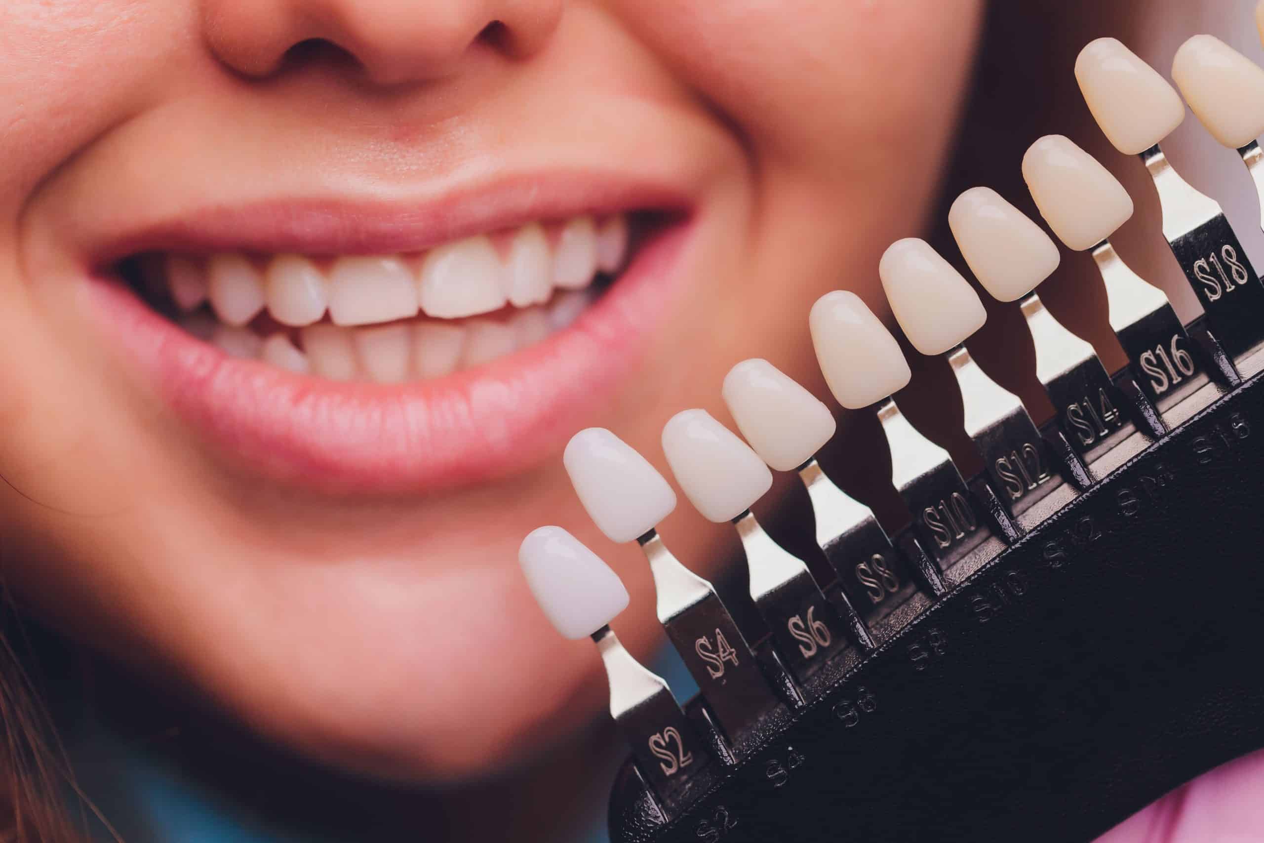 Dental Veneers: Procedure, Benefits, Types, and Aftercare