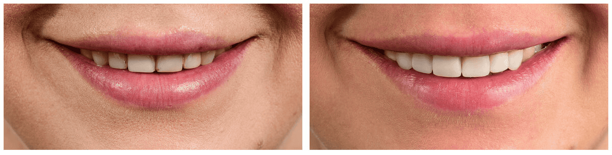 From Flaws to Flawless: Composite Veneers Before and After