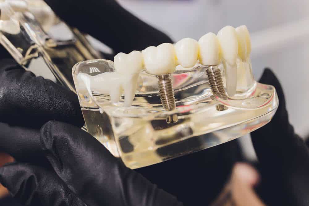 Dental Implant Cost Factors: What Affects the Price of Implants