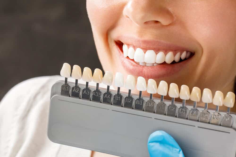 How Do Dental Veneers Work? Are They Worth It?