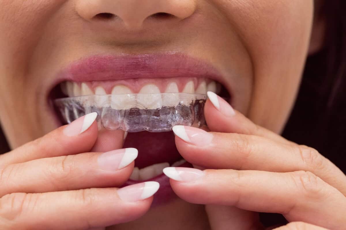How To Straighten Your Teeth? Braces and Invisalign Explained